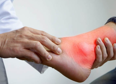 TRỊ LIỆU GOUT – GIẢM VIÊM SƯNG, ĐÀO THẢI AXIT URIC, ỔN ĐỊNH CƠ THỂ