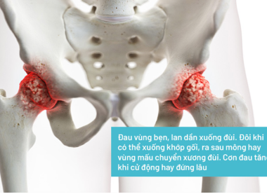 Trị Liệu Viêm Khớp Háng – Giảm Đau, Phục Hồi Vận Động Tự Nhiên