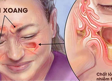  ĐIỀU TRỊ VIÊM XOANG MÃN TÍNH THEO PHƯƠNG PHÁP Y HỌC VIỆT & PHẢN CHIẾU VI CƠ THỂ