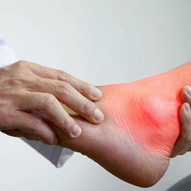 TRỊ LIỆU GOUT – GIẢM VIÊM SƯNG, ĐÀO THẢI AXIT URIC, ỔN ĐỊNH CƠ THỂ