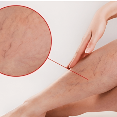 TRỊ LIỆU SUY GIÃN TĨNH MẠCH – GIẢM SƯNG PHÙ, ĐAU NHỨC, TÁI TẠO TUẦN HOÀN MÁU