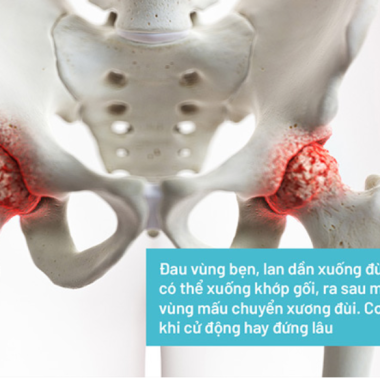 Trị Liệu Viêm Khớp Háng – Giảm Đau, Phục Hồi Vận Động Tự Nhiên
